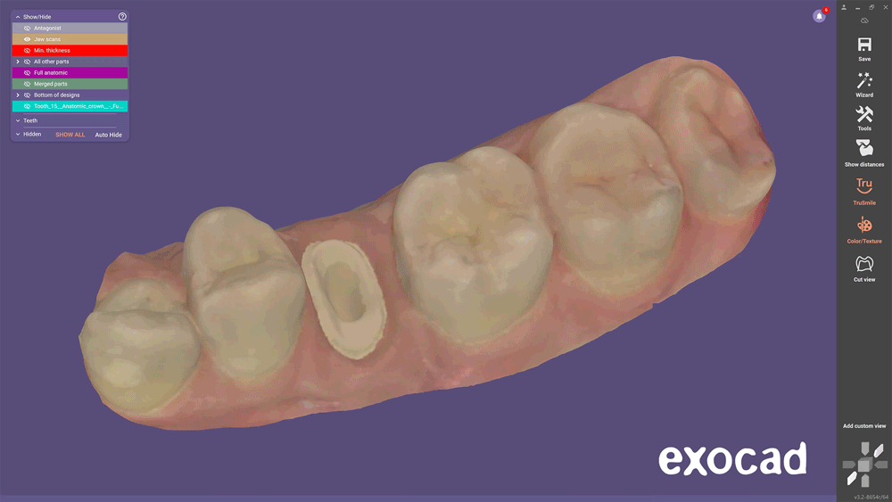 exocad DentalCAD Elefsina post & core