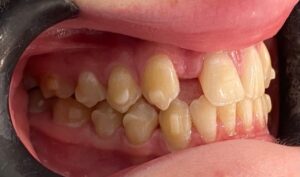 VOCO Grandio case post-Invisalign treatment