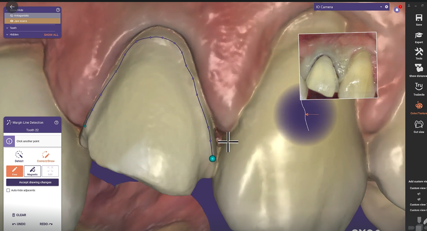 Margin marking with exocad CAD software