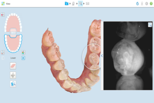 iTero intraoral scanner with NIRI (caries detection) technology