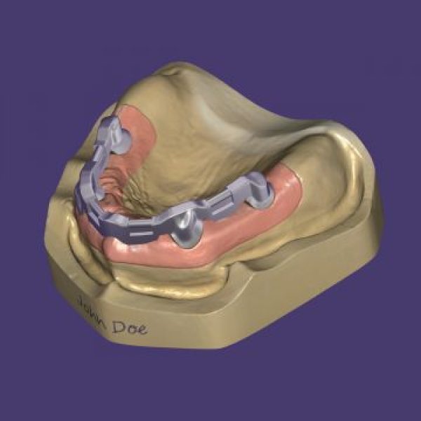 exocad DentalCAD Bar Module