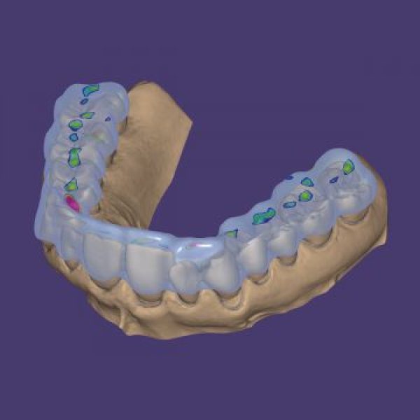 exocad DentaCAD Bite Splint module