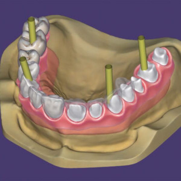 DentalCAD_Whatsnew_generic__Page_11_Screen_ImplantModule