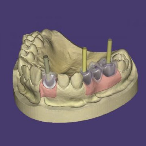exocad DentalCAD Implant module