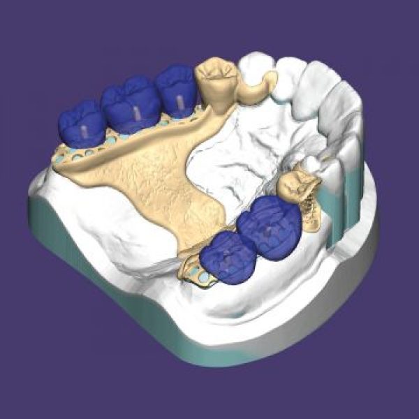 exocad DentalCAD PartialCAD module